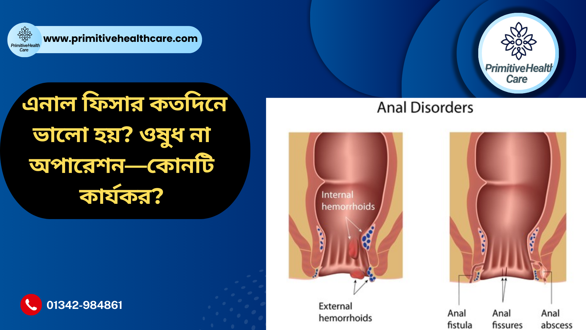 Anal Fissure Treatment Medicine-or Surgery